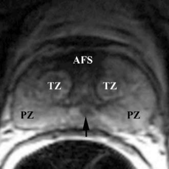 Axial image of the prostate base, that constitutes the upper 1/3 of the gland just below the urinary bladder, shows the following anatomical zones: anterior fibromuscular stroma (AFS) containing