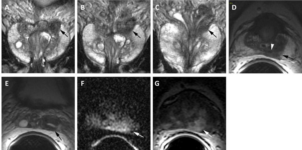 Figure 8- Central Zone Prostate Cancer MRI performed at 1.