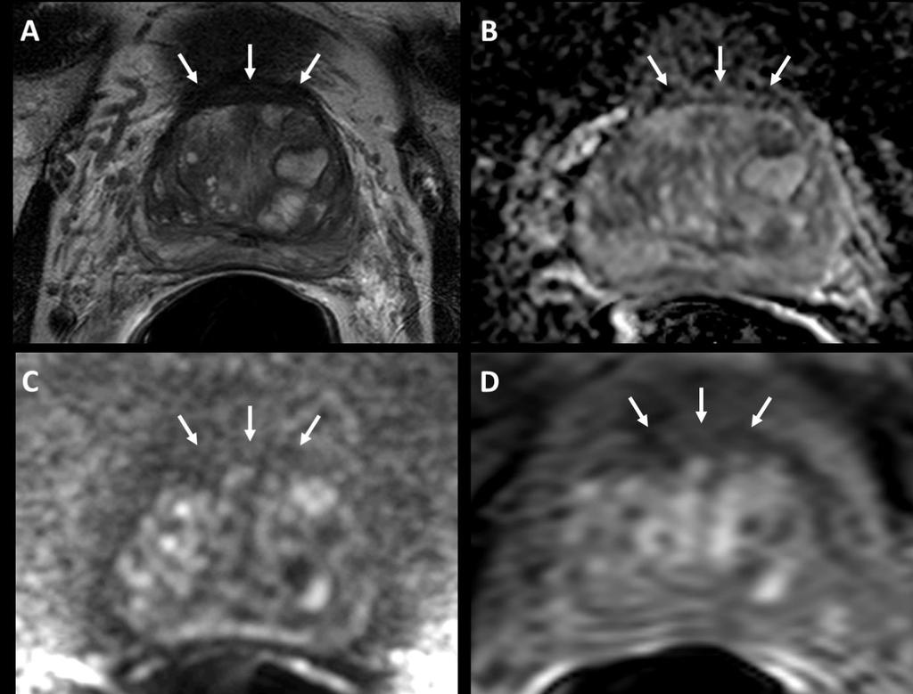 Figure 9. Normal Anterior Fibromuscular Stroma (AFMS).
