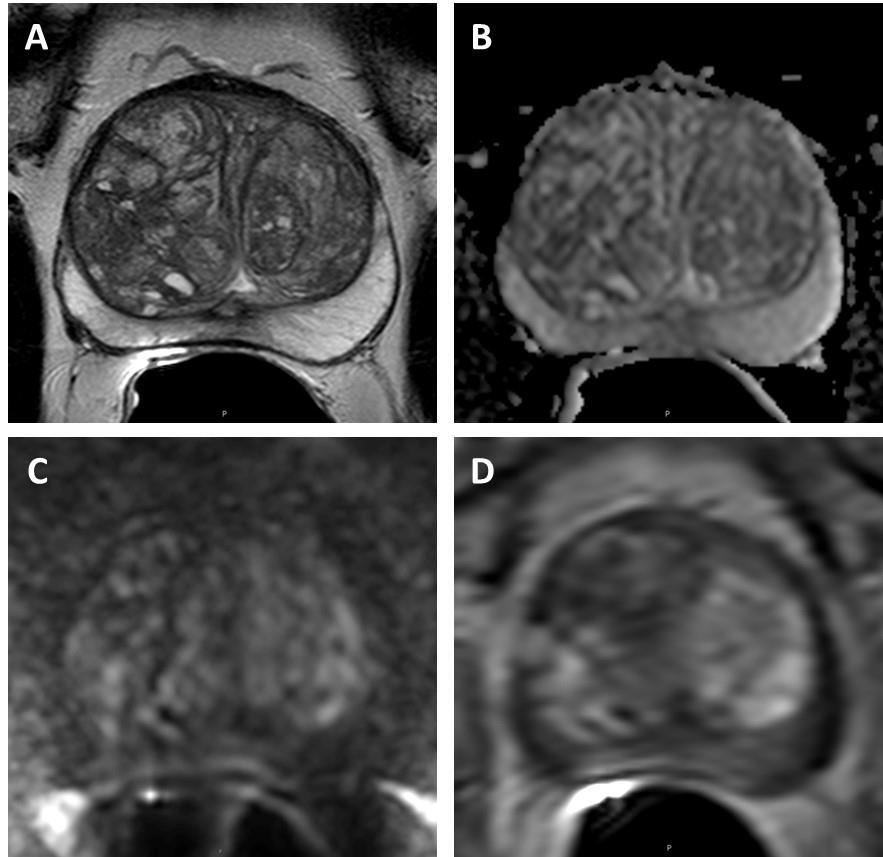 Figure 11. Transition Zone with Typical Benign Prostatic Hyperplasia. A. Axial T2-weighted image shows completely encapsulated typical nodules creating the organized chaos pattern. B. ADC map shows no focal lesion with low signal intensity below the background.