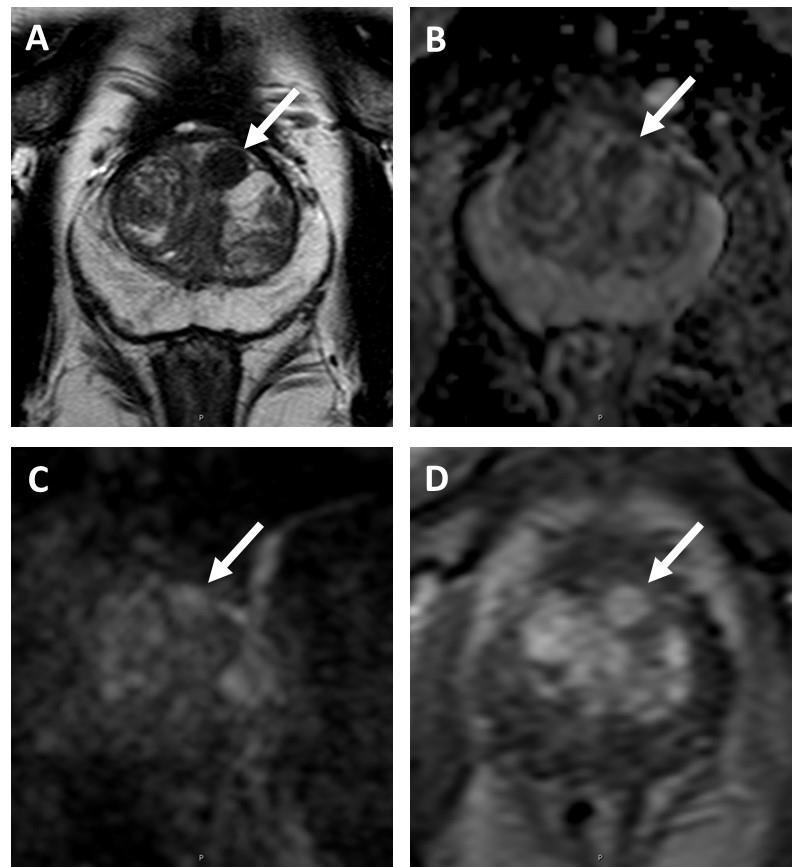 Figure 12. Transition Zone with an Atypical Nodule. A. Axial T2-weighted image shows a homogeneous T2 hypointense mostly encapsulated nodule (arrow). B.
