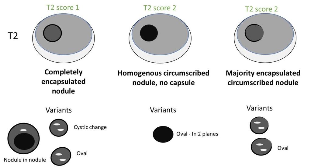 Figure 13. Schematic diagram of features of nodules in the TZ and their corresponding scores.
