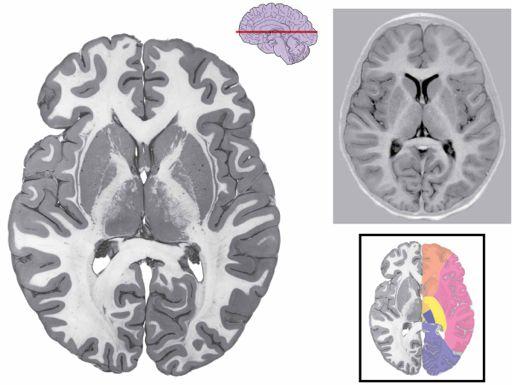 !! (cerebral cortex = gold; thalamus = blue/purple; midbrain = orange; pons = purple, cerebellum = blue; medulla = red/orange; spinal cord = green)!