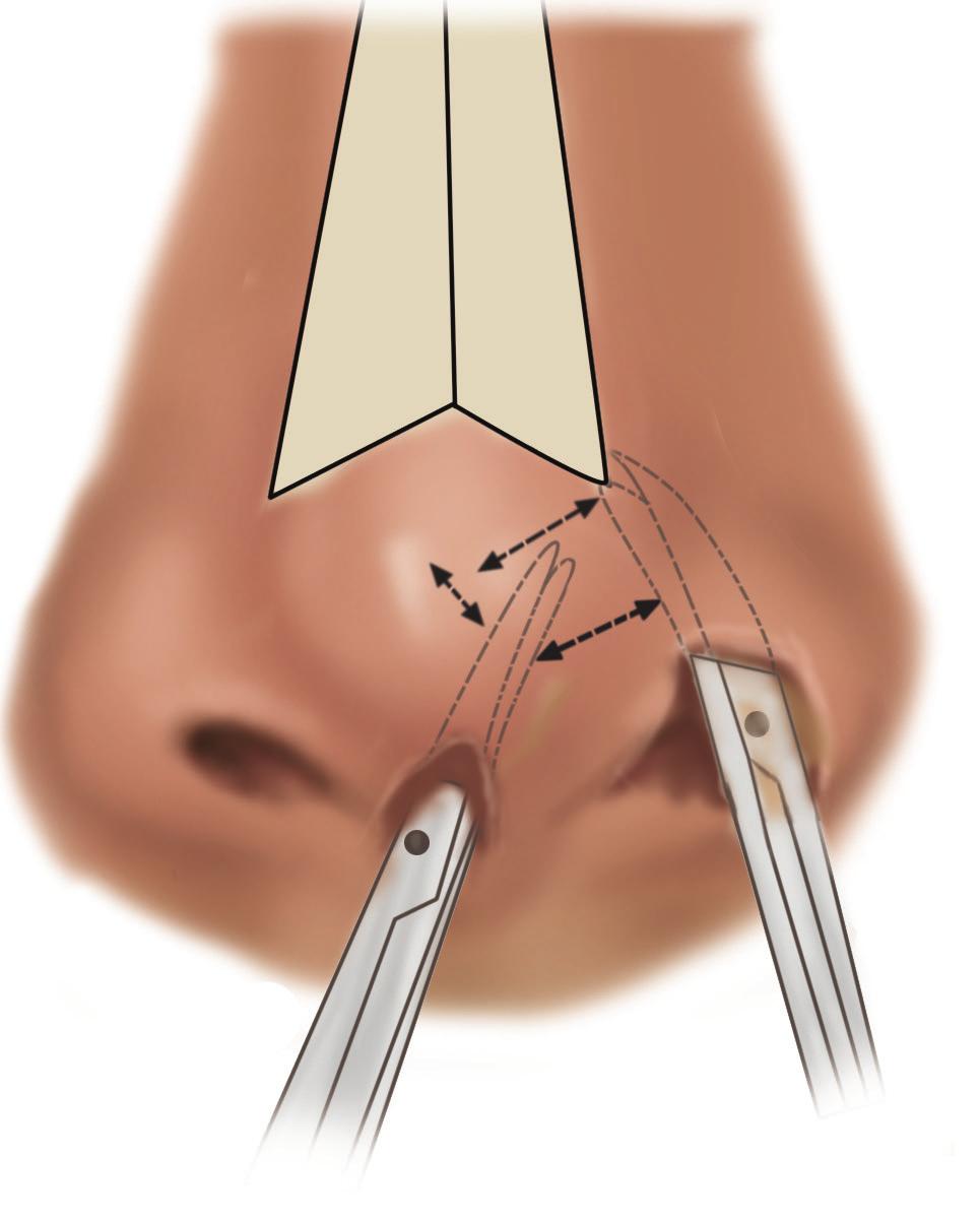 Unilateral Cleft Lip 49 a Fig. 3.