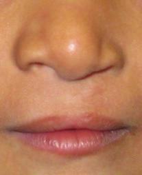 Primary Gingivoperiosteoplasty Technique The alveolar cleft in complete clefts of the primary palate should be addressed either at the time of primary cleft lip repair or secondarily.