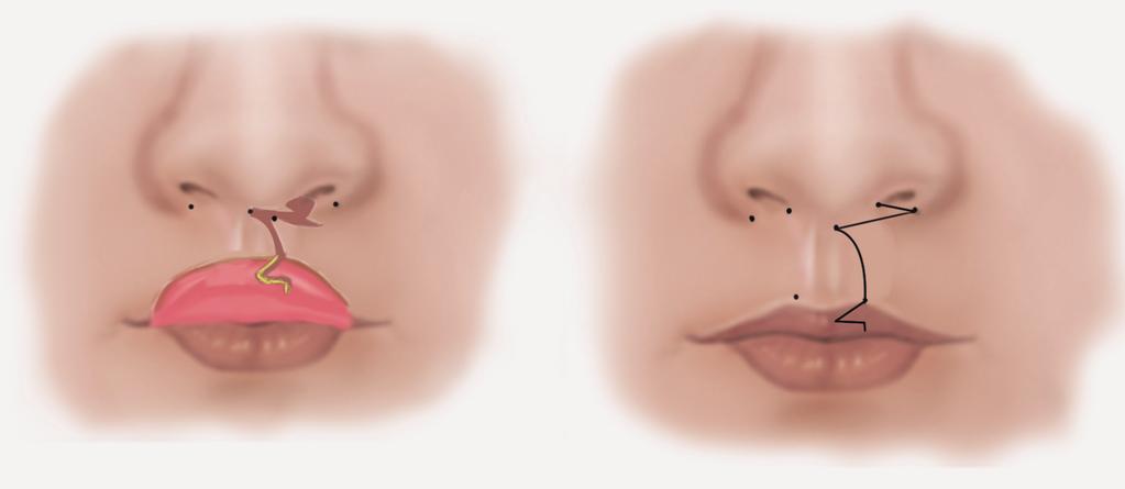 Reddy believes that this incision is versatile and gives good scars and also adequate lengthening of the lip.