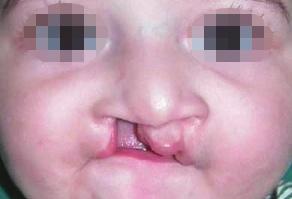 40 Cleft Evaluation of the Cleft and the Nature of the Deformity The child is carefully evaluated to determine the nature of the cleft whether unilateral or bilateral (Box 3.1).