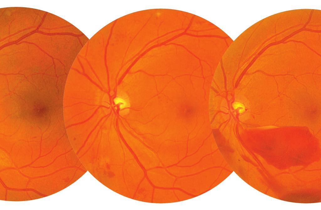 SPOTLIGHT ON PHOTO: NCL DESP AT NMUH NHS TRUST Diabetic retinopathy is no longer the leading cause of blindness among people of working age thanks, at least in part, to retinal screening.