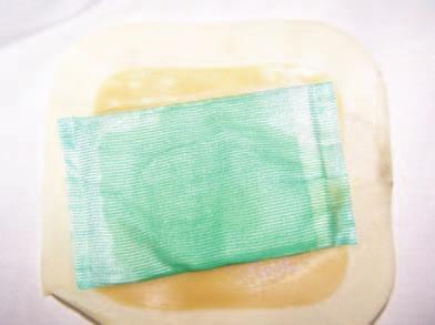 Figure. Cutimed Sorbact pad held in place by a hydrocolloid. Cutimed Sorbact can be used under any dressing or bandage as long as there is no other fatty substance present, such as cream or ointment.