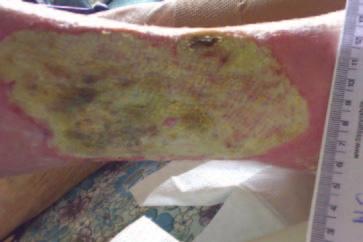 orthopaedic wool and a K-lite bandage. The first dressing change was made two days later.