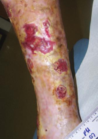 Within a week, Patient A no longer had pain (recorded as a 0 on the pain scale). After two weeks, large areas of epithelial tissue were visible and one of his major wounds had reduced in size by 50%.