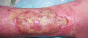 5cm (Figure 0), but the patient gave a pain rating of 0 (no pain experienced). Wound management objectives were to debride the necrotic tissue, manage the exudate and promote granulation tissue.