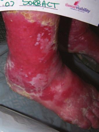 Figure 5. This patient had suffered with an inflamed and weeping wound for many years. The wound was superficial, painful and covered most of her lower limb. Figure 6.