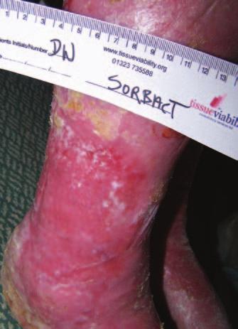 stretches of epithelial tissue were noted and the redness had subsided (Figure 6).