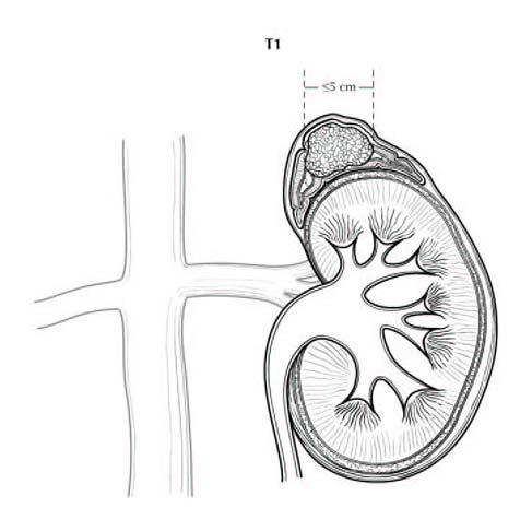 Figure 1. T1: Tumor 5 cm in greatest dimension, no extra-adrenal invasion. Used with the permission of the American Joint Committee on Cancer (AJCC), Chicago, Illinois.