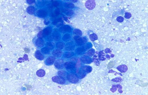 Carcinomas: a malignancy arising from epithelial cells (skin and linings). The cells tend to clump together on cytology.