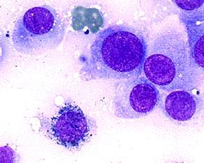 Malignant Melanoma Mast Cell Tumor Plasma Cell Tumor Lymphoma (considered a round cell tumor) is a very common cancer diagnosis in
