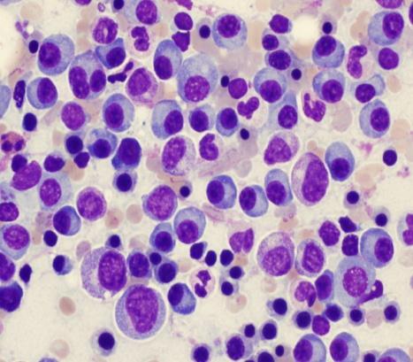 size. In addition, plasma cells and occasional mast cells are seen in the reactive node.