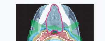 IMPT Intensity modulated proton therapy (IMPT) Radiation portals which adds more