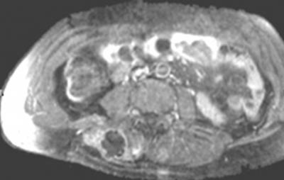 Figure 12 (a) Recurrent high-grade chondrosarcoma of the right iliac bone on axial MR images obtained 6 months after resection.