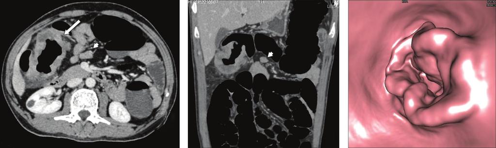 2a 2b 2c Fig. 2 A 46-year-old man presented with abdominal pain and weakness.