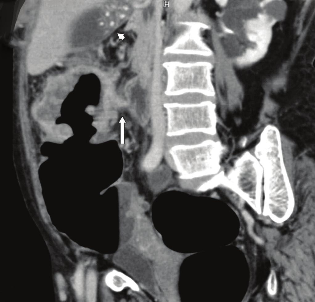 Fig. 4 A 75-year-old woman presented with per rectal bleeding and abdominal pain.