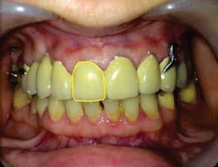 metal fits very well uncover the smile only on half incisal teeth, clasps 1/3 split being anchored in the incision