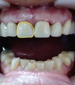 can replace missing teeth support that are used, help the doctor not to invade the aesthetic component of partial