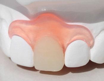 The accurate shade and high translucency present in Bayflex blends with patients natural tissue tone.