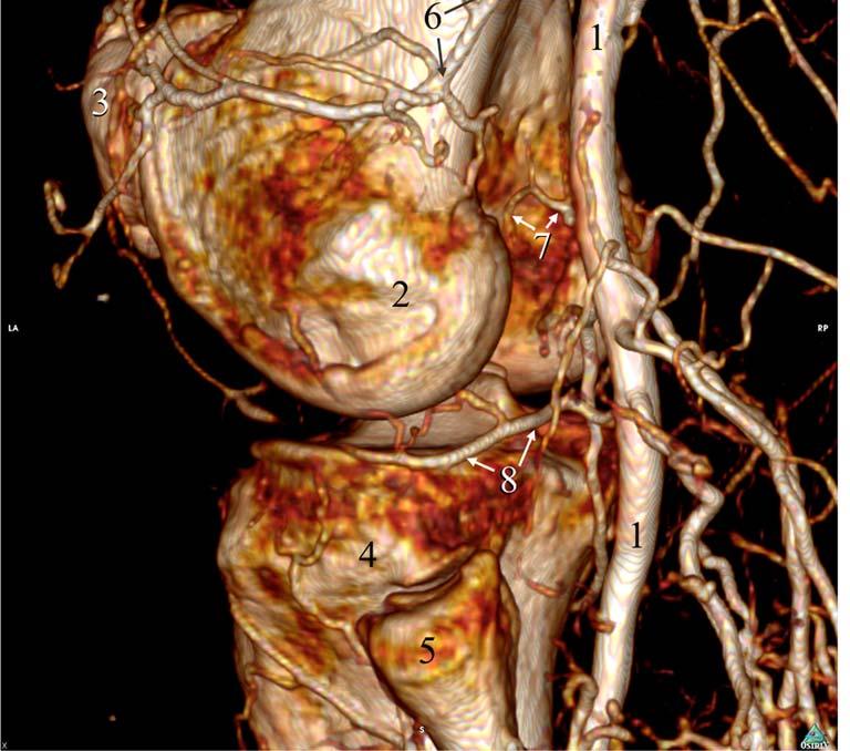 Periarticular Genicular Anastomosis - medial sup. genicular a.