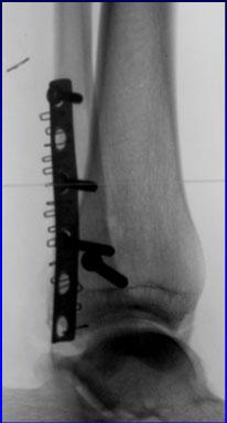 Post-op Weber B Injuries Associated with