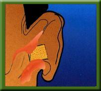 Push the ear plug into the ear canal and hold there for a few seconds until it expands and fills the ear