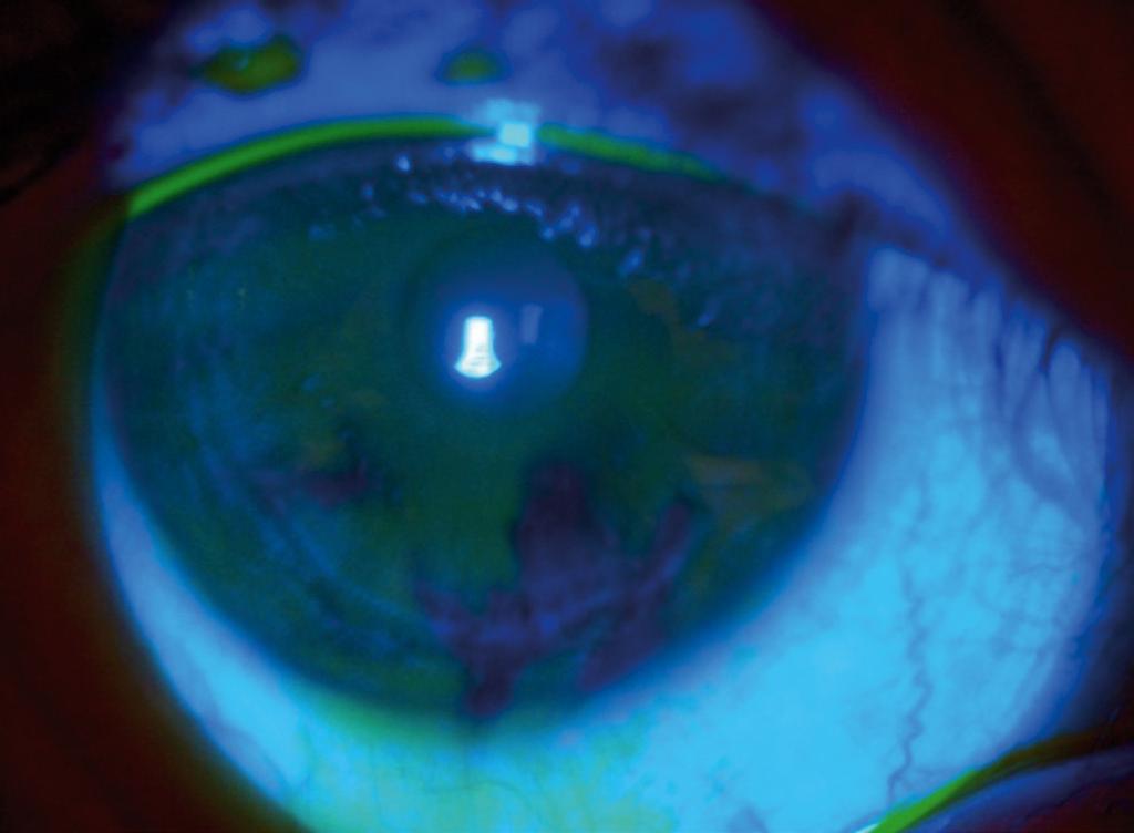 We recognise that by improving the ocular surface, we can improve refractive surgery outcomes. OSD is the main complication after cataract and refractive surgery.