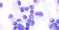 or sever osteopenia New myeloma defining events (MDEs) 60% clonal BM plasma cells Serum involved/uninvolved