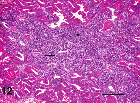 Vol. 36, No. 7, 2008 WEIGHT AND APPEARANCE OF PROSTATE IN BEAGLE DOGS 923 FIGURE 12. Lymphoid cell inflammation with atrophy of adjacent acini. Bar = 300 µm.