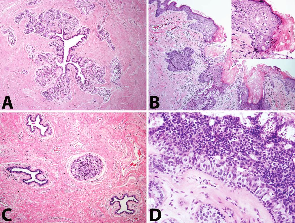 Figure 2. A, A lactiferous duct with surrounding terminal duct lobular unit involved by lobular carcinoma in situ. B, Paget disease of the nipple.