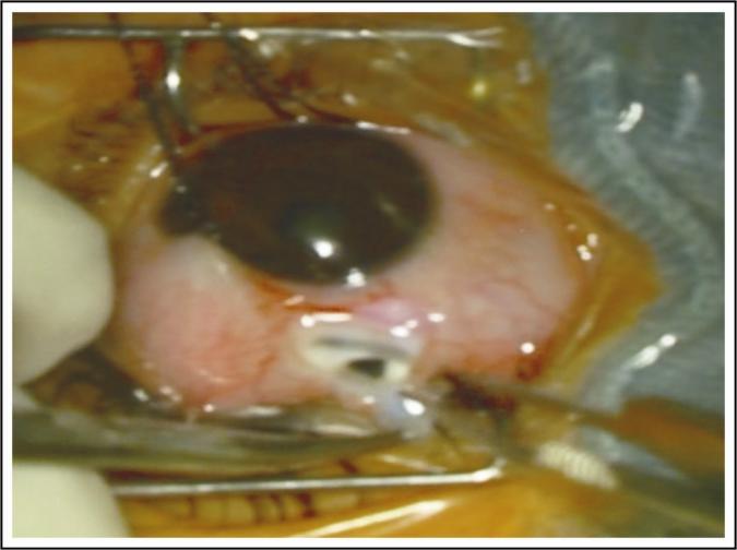 SCLERAL PATCH GRAFT IN SPONTANEOUS AND TRAUMATIC CORNEOSCLERAL PERFORATIONS Causing of Cornea with Thinning 15 67 M OS CF AT 2 FT Traumatic Scleral Right eye (OD), Left eye (OS) Corneoscleral patch