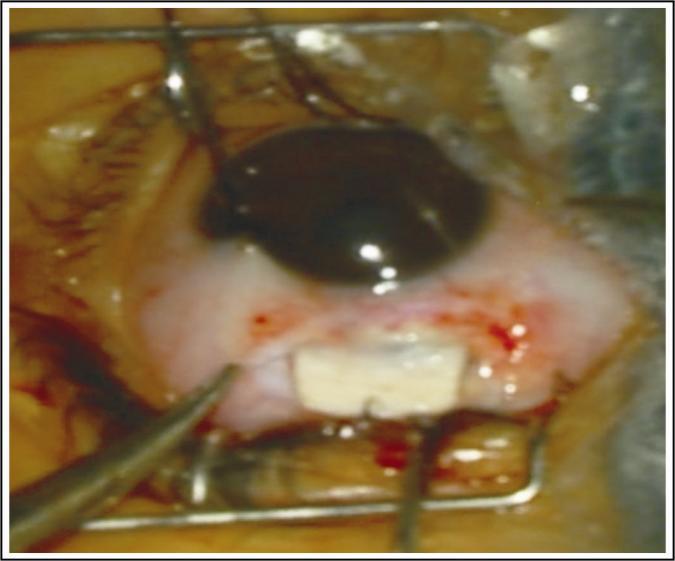 (VA) SPG CF AT 5 FT Stable Ocular Fig. 1: Pre- operative Scleral thinning after traumatic scleral perforation with a Nail.