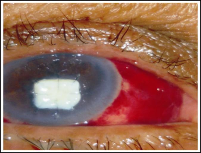 SHARJEEL SULTAN, et al and one eye was eviscerated due to late onset endophthalmitis. This study has numerous limitations, including the loss of patients to follow-up and incomplete records.