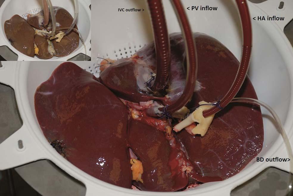 BROCKMANN ET AL. LIVER TRANSPLANTATION, May 2017 FIG. 6. Normothermic liver perfusion of a DCD liver graft.