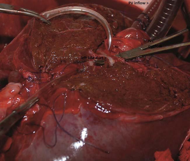 Perfusion was paused in order to separate the grafts. The left hepatic artery was ligated to the right and thereafter divided. In the following the left portal vein and left hepatic vein were divided.