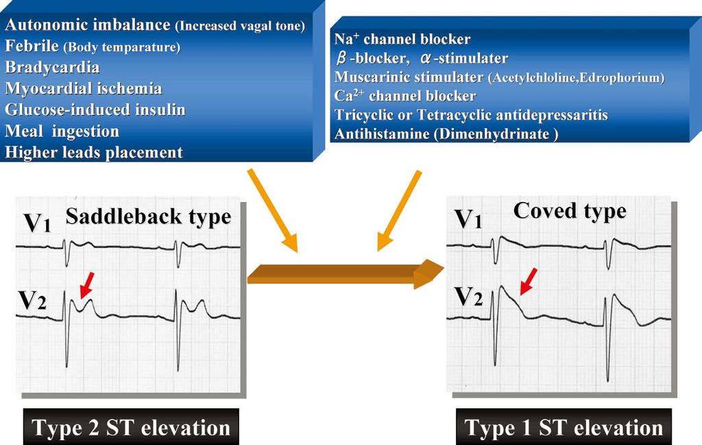 (Con) Low Risk of Drug-Induced Type 1 ECG 2465 Figure 1. Multiple factors influencing ST-T wave in Brugada syndrome.