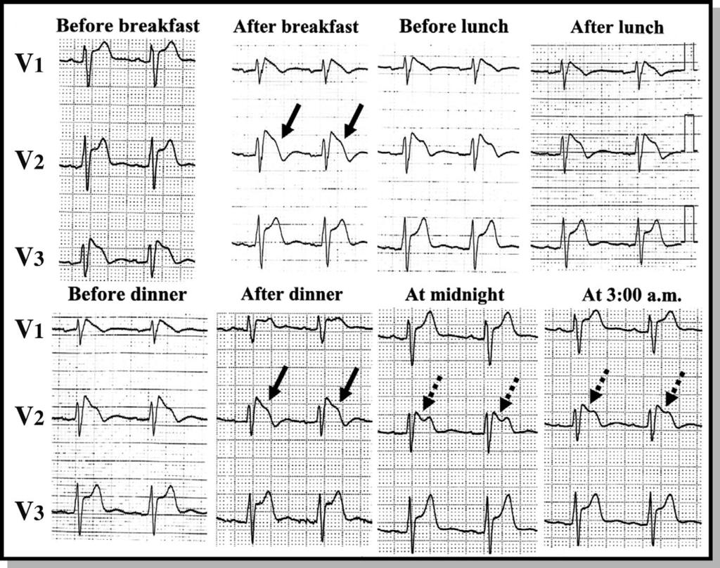 2470 NISHIZAKI M et al. Figure 7. Variation in ST elevation associated with taking a meal in a patient showing a transient type 1 ST elevation.
