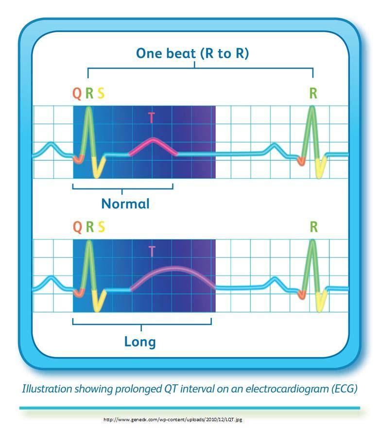Long QT Syndrome The electrical activity that occurs between the Q and T waves is called the QT interval. This interval shows electrical activity in the heart's lower chambers, the ventricles.
