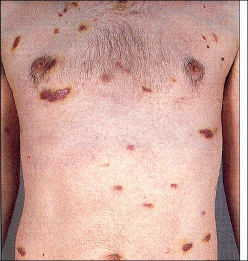Kaposi s sarcoma (shown) is a rare cancer of the blood vessels that is associated with HIV.