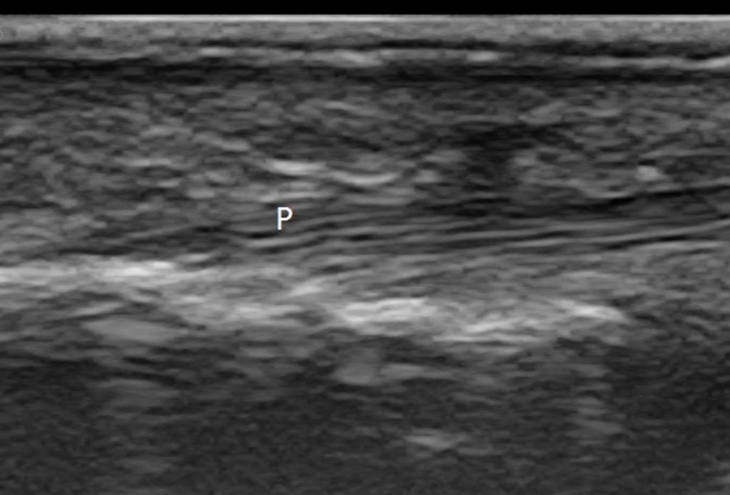 Fig. 9: Axial scan of the flexor digitorum tendon The flexor digitorum profundus tendon originates from the anterior and medial aspects of the ulna.