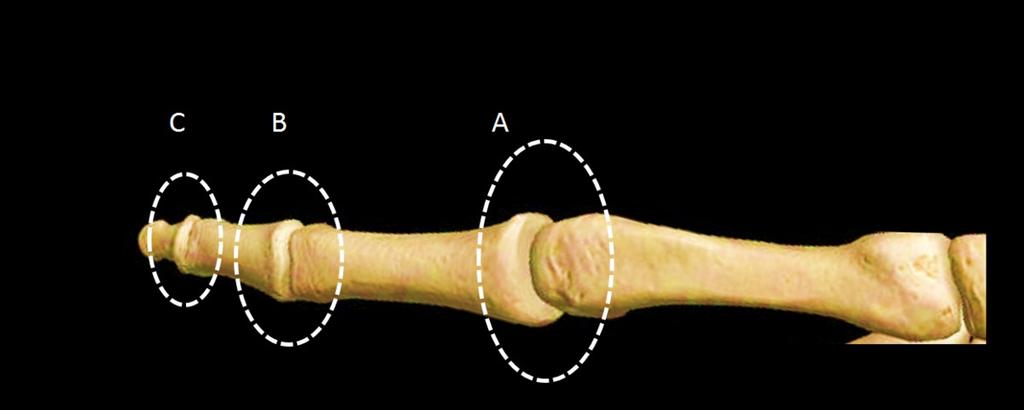 Lumbrical muscles reach the MCP joint at its radial aspect and run palmar to the deep transverse metacarpal ligament and to the transverse axis of the joint, thus acting as flexors for the MCP joint.
