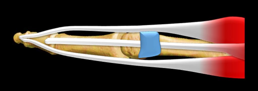 Fig. 21: Longitudinal view of the ulnar collateral ligament of the thumb DORSAL SIDE: Check-list: 1. Extensor digitorum communis tendon 2. Extensor digitorum superficialis tendon 3.