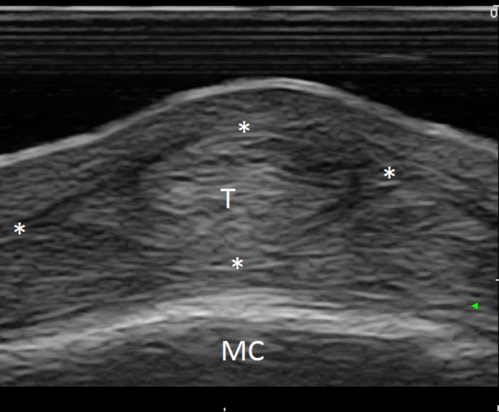 Fig. 23: Axial view: T: extensor tendon;