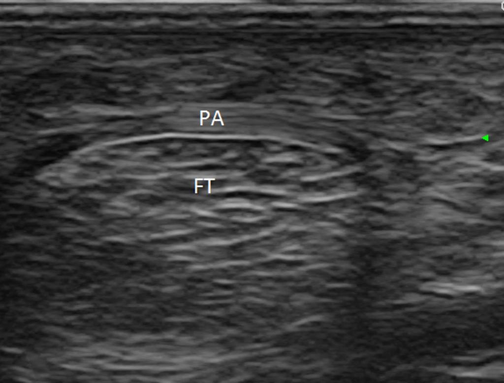 Fig. 2: Axial scan of the palmar aponeurosis.